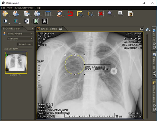 Weasis free x-ray viewer software